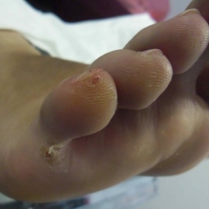 Plantar Wart On Toe Tip And Under Toe.