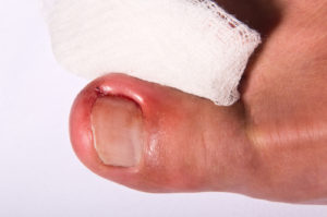 Ingrown Toenail Treatment 3